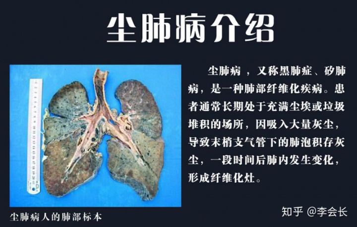 重疾險