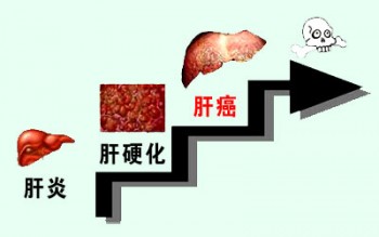 有肝硬化可以買重疾險嗎？肝硬化是怎么引起的？