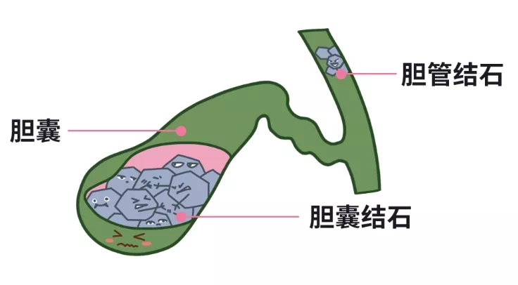 膽結(jié)石買保險