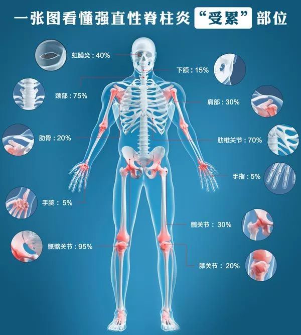 強(qiáng)直性脊柱炎可以買(mǎi)重疾險(xiǎn)嗎
