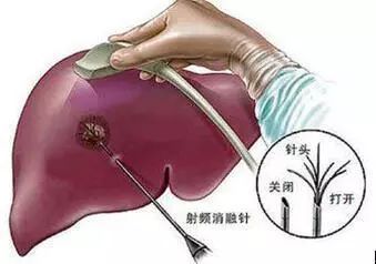 肺部結(jié)節(jié)可以買的重疾險？投保重疾險保額要考慮哪些因素？